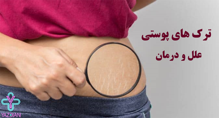 محصولات رفع ترک بدن و پا